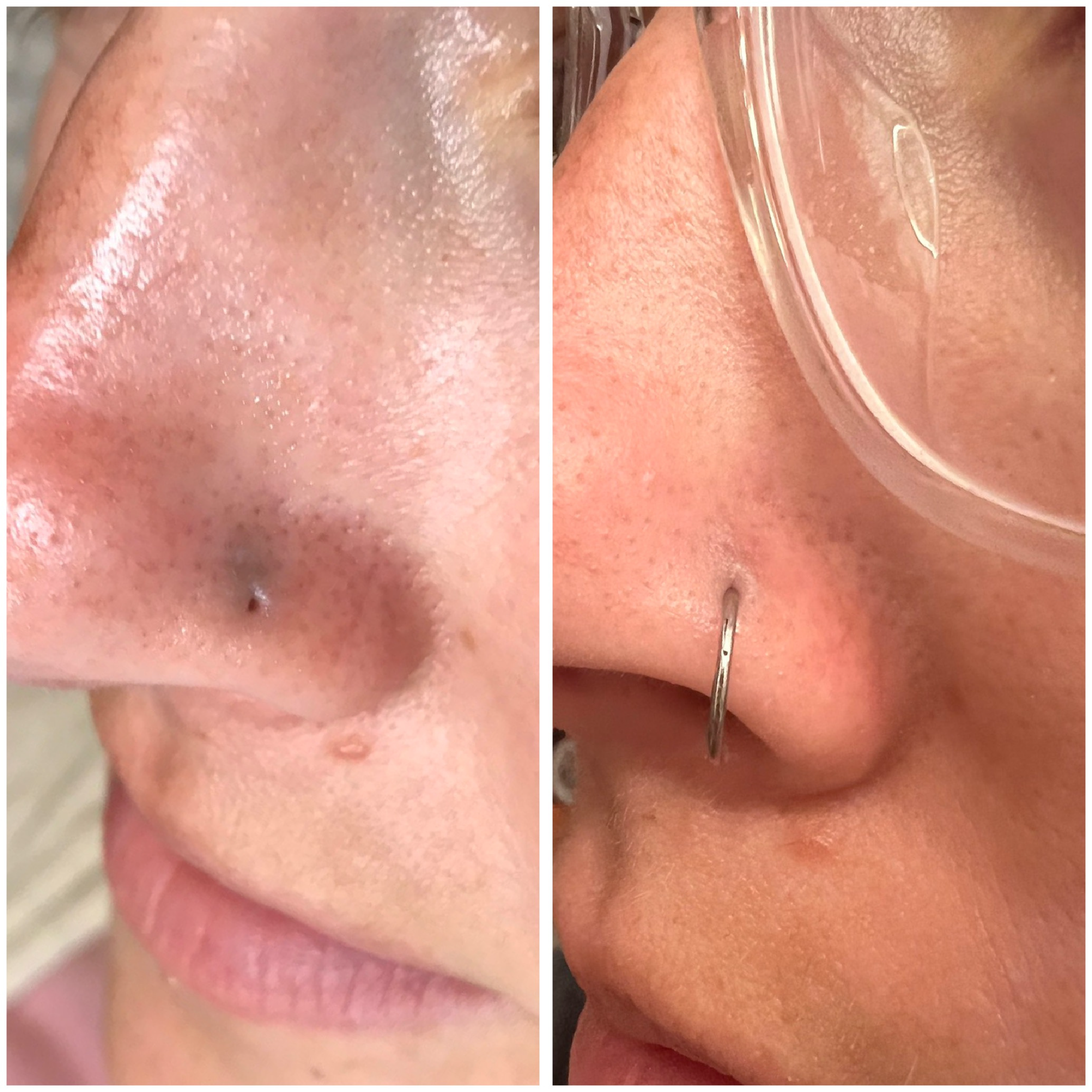 Nose Piercing Scar Restoration from Revival Skin + Artistry