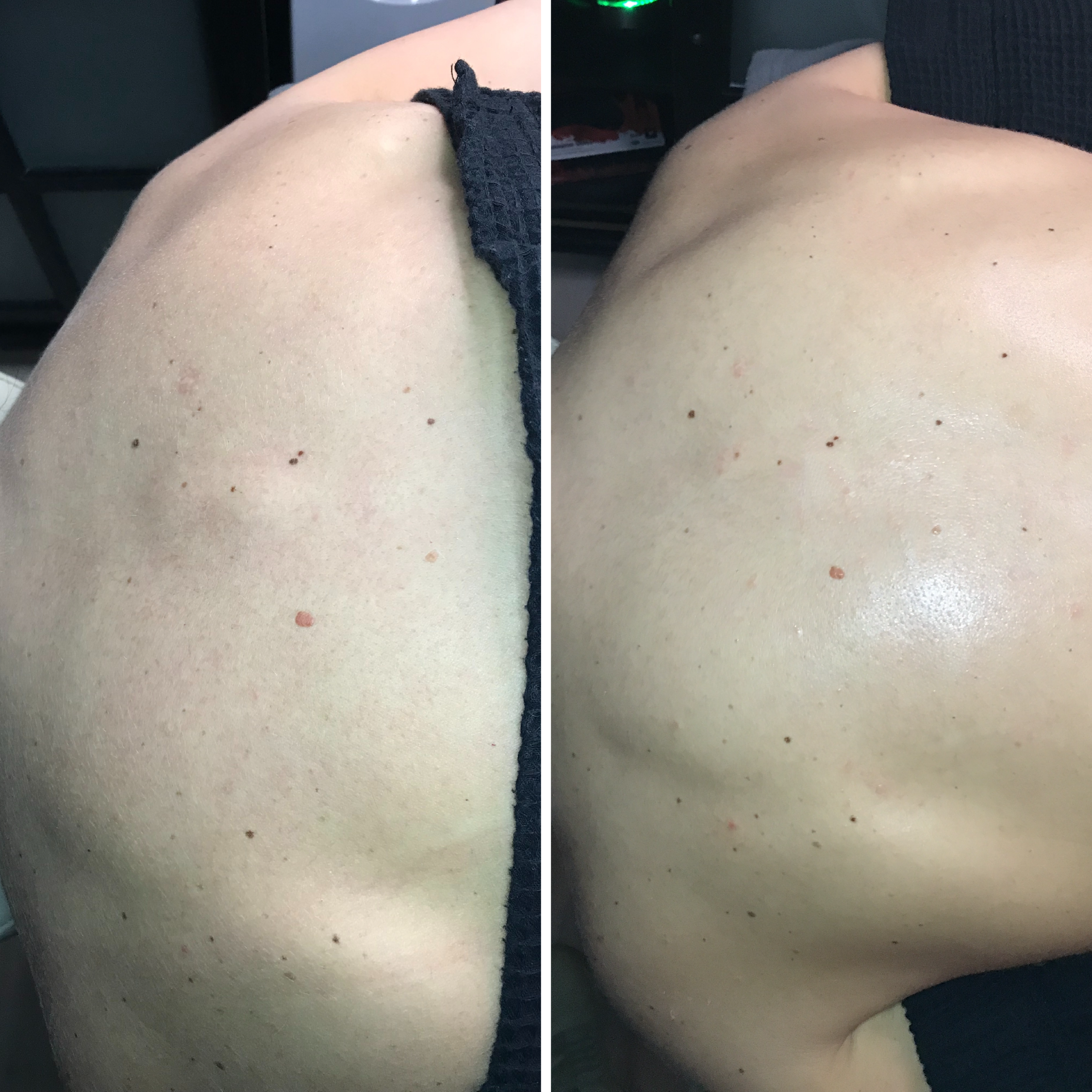 Back Facial from Revival Skin + Artistry