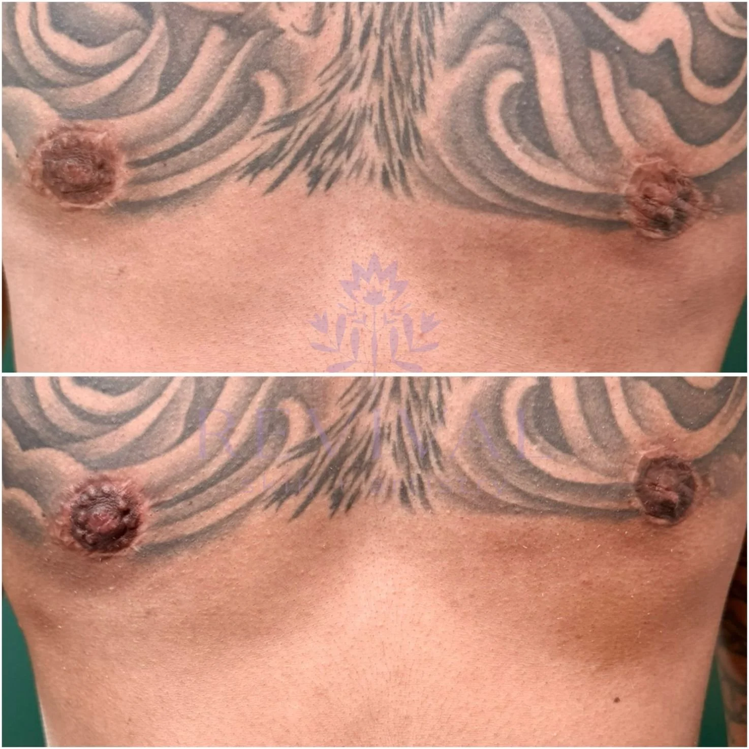 Areola Repigmentation 