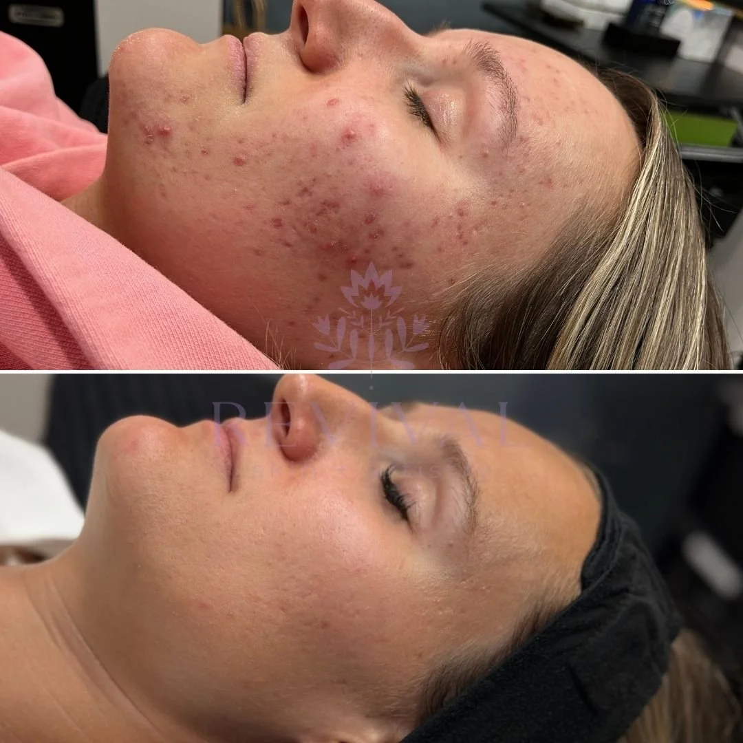 Microneedling Denver