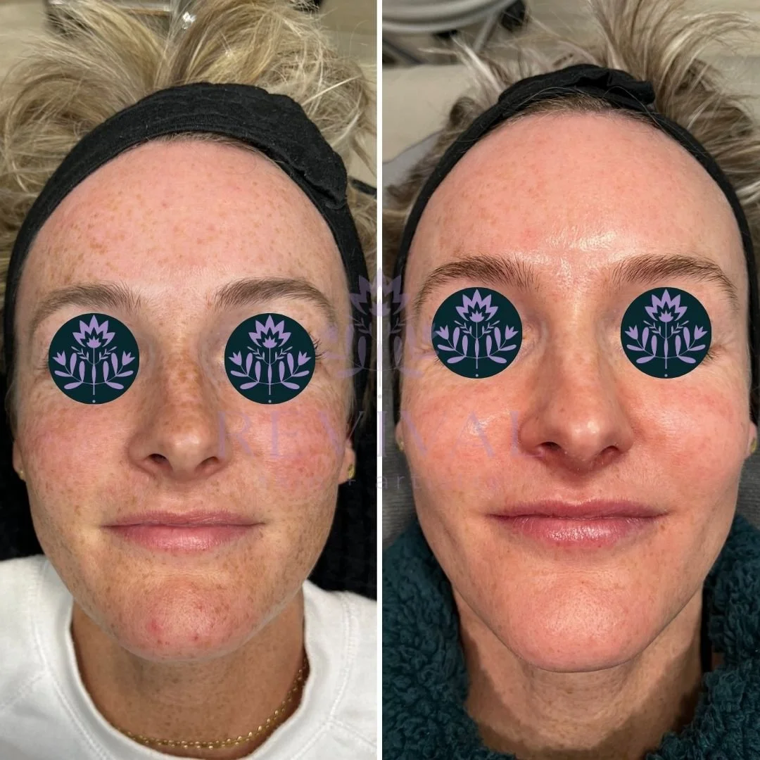 Hyperpigmentation Denver Microneedling