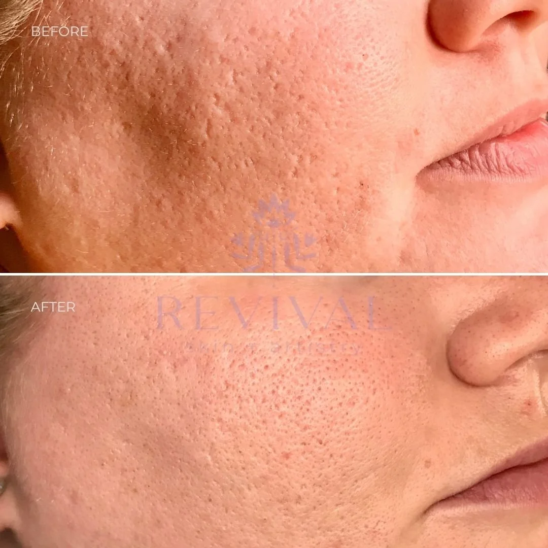 microneedling for large pores