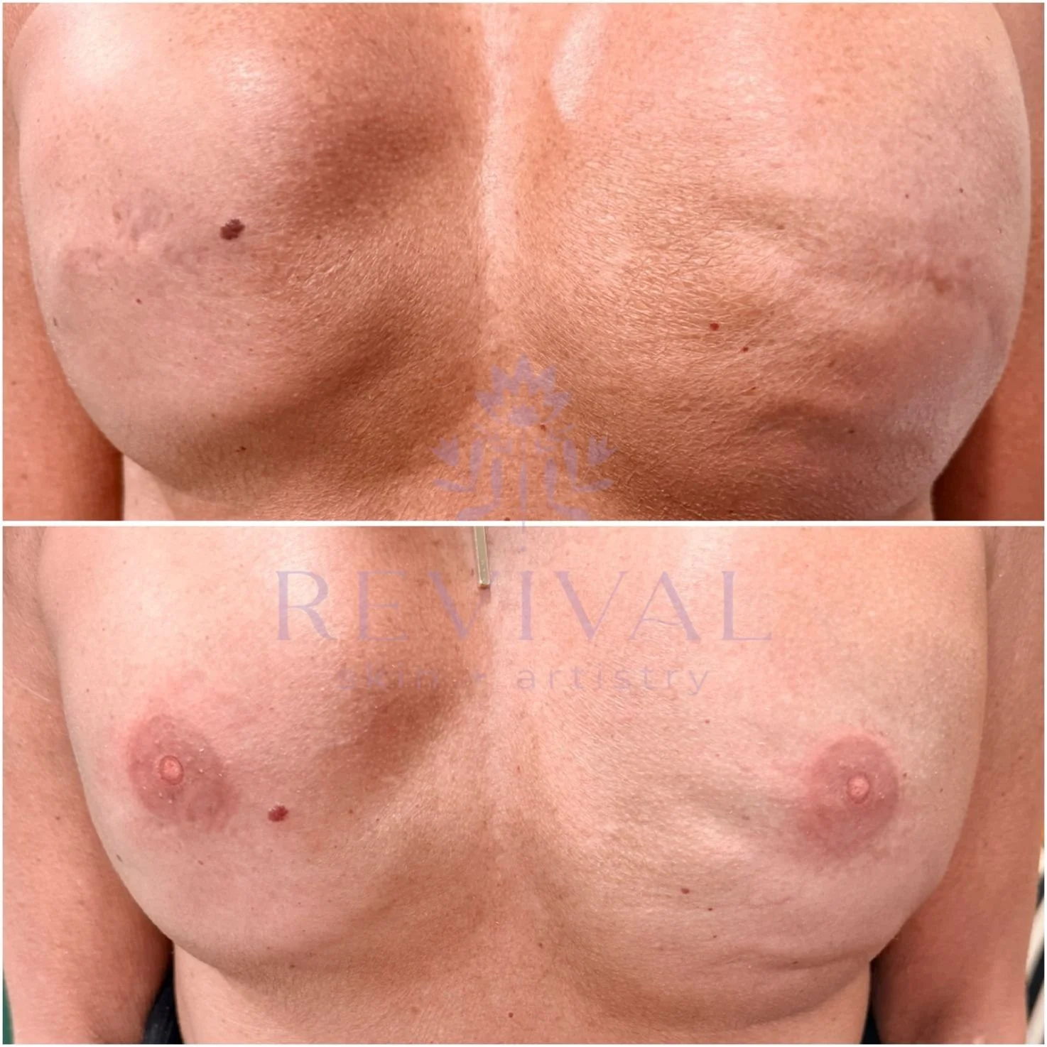 Bilateral Areola Tattoo
