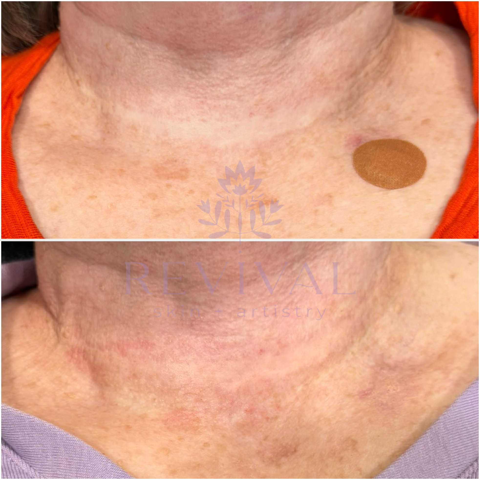 Thyroid Neck Scar Camouflage