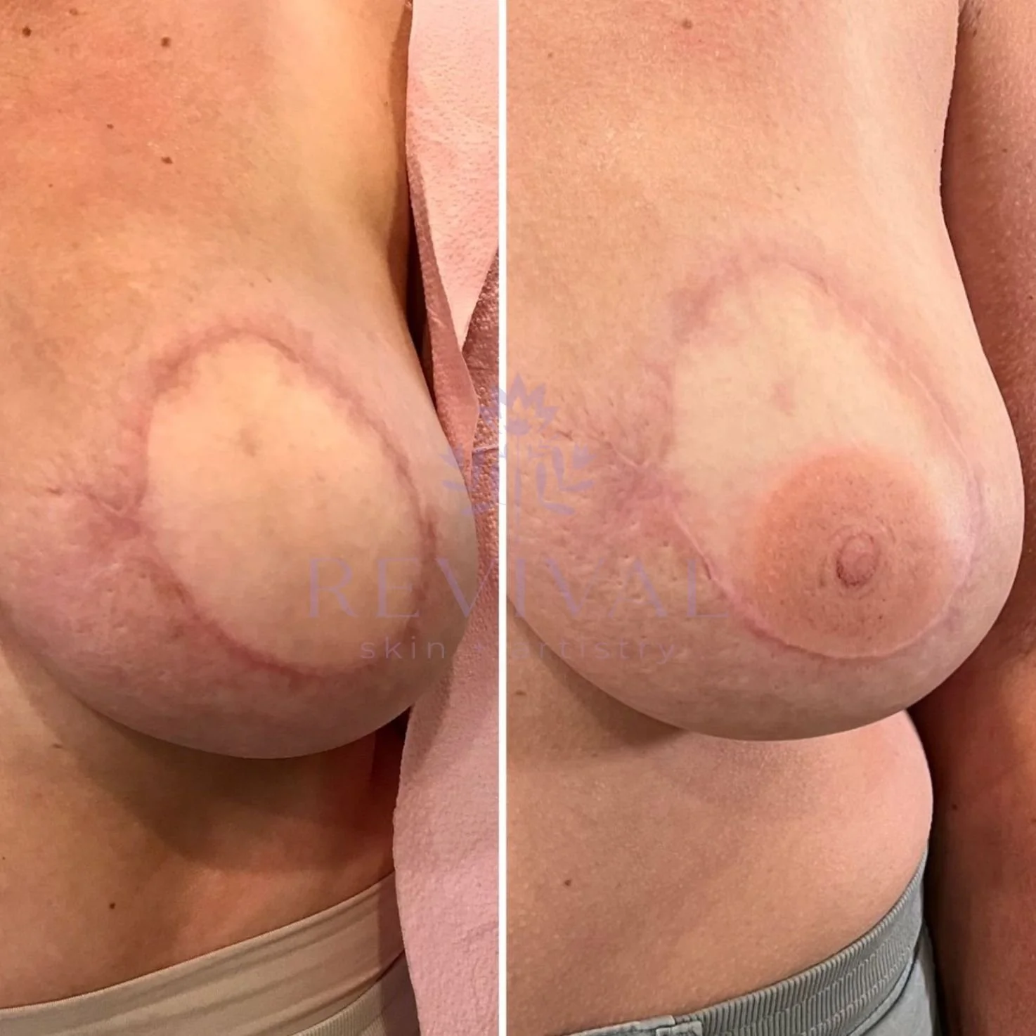unilateral nipple tattoo before and after