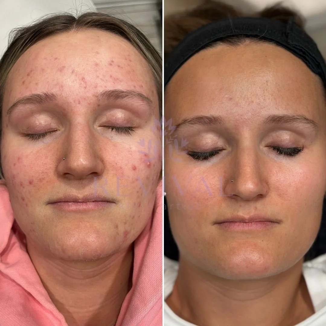 Microneedling Denver