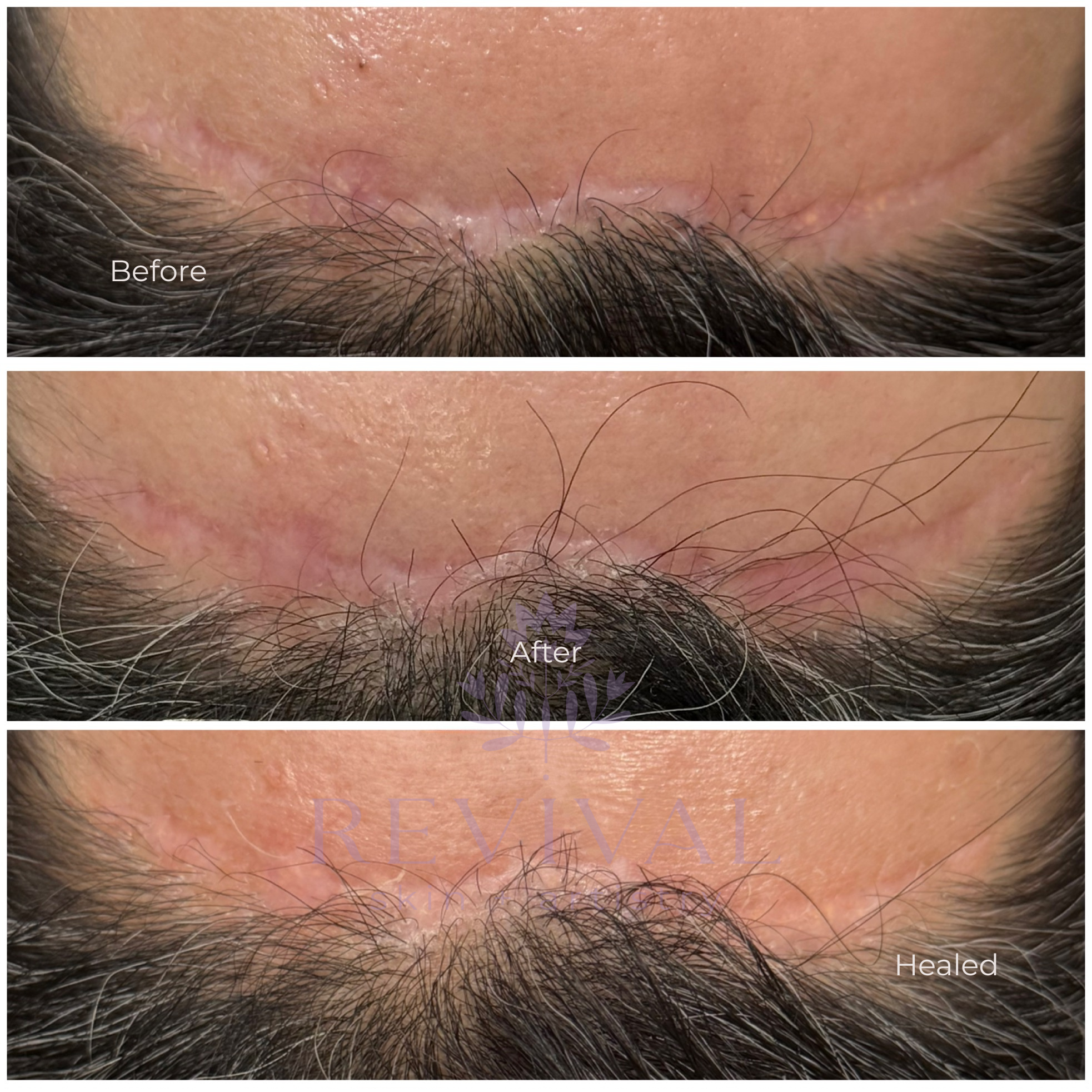 Scar Camouflage Denver