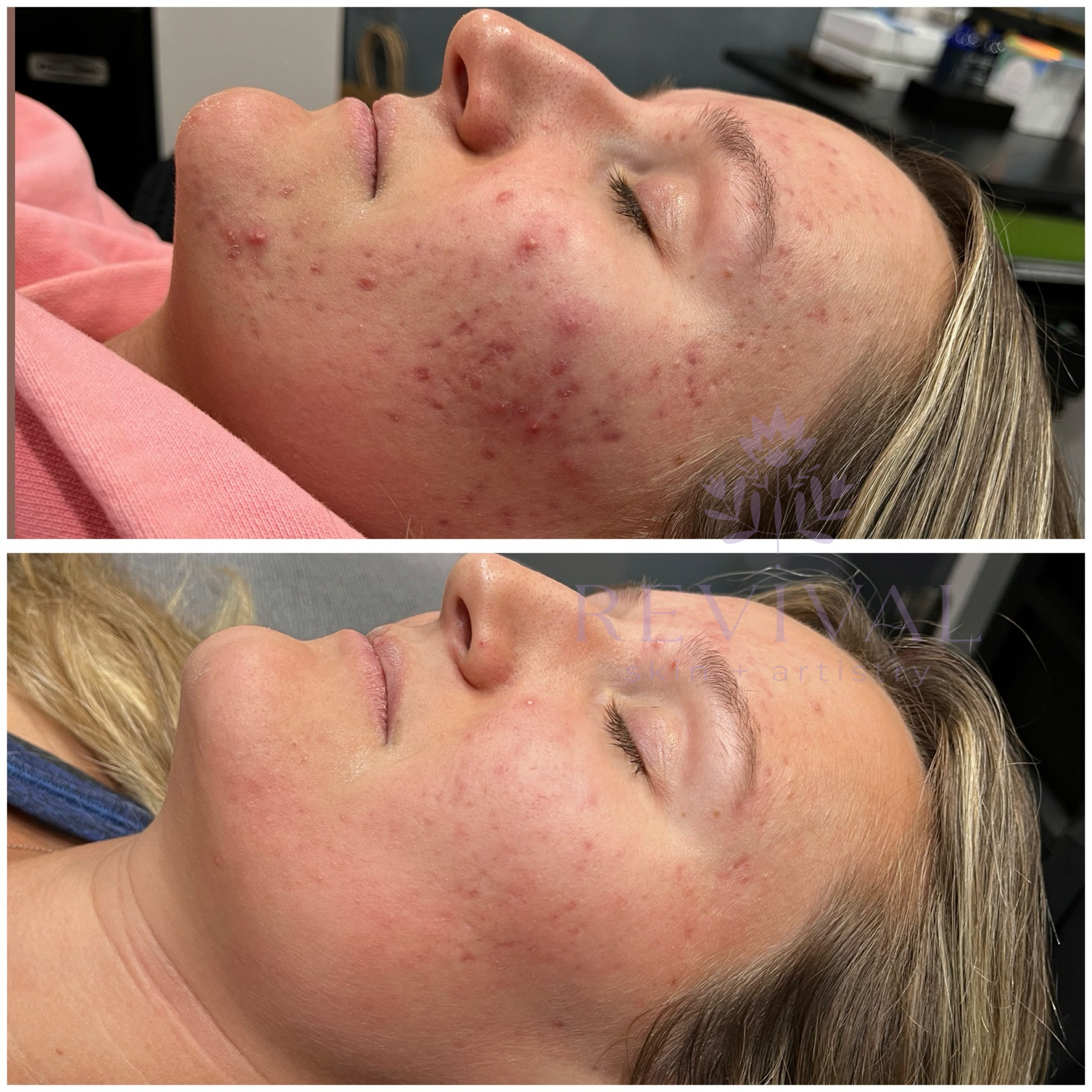 acne treatment before and after