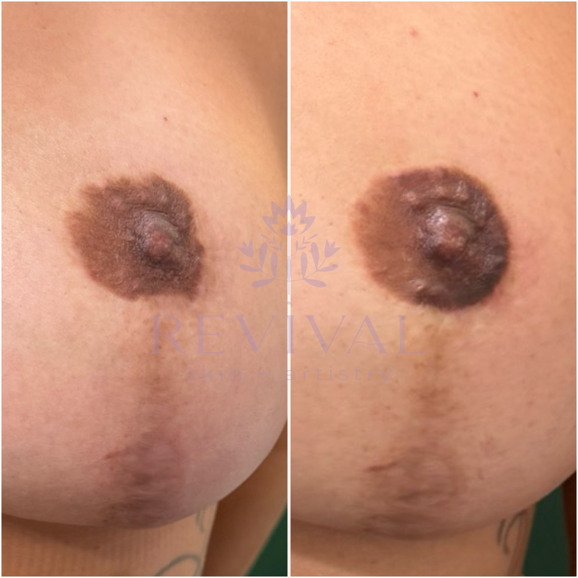 Nipple Shape Correction