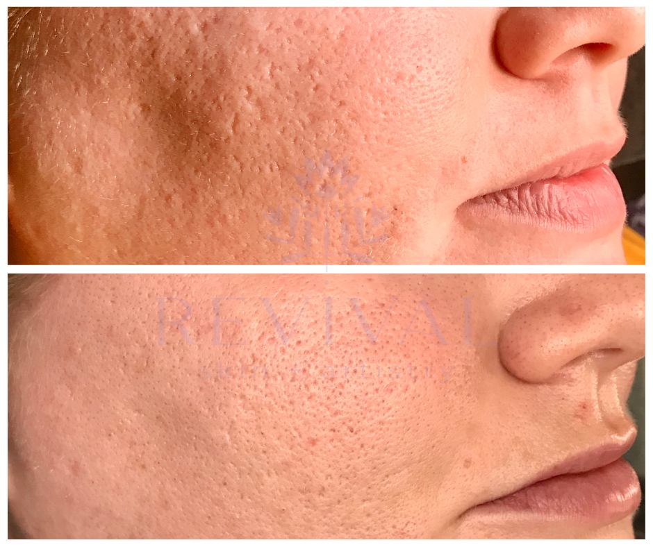 Microneedling for texture denver.png