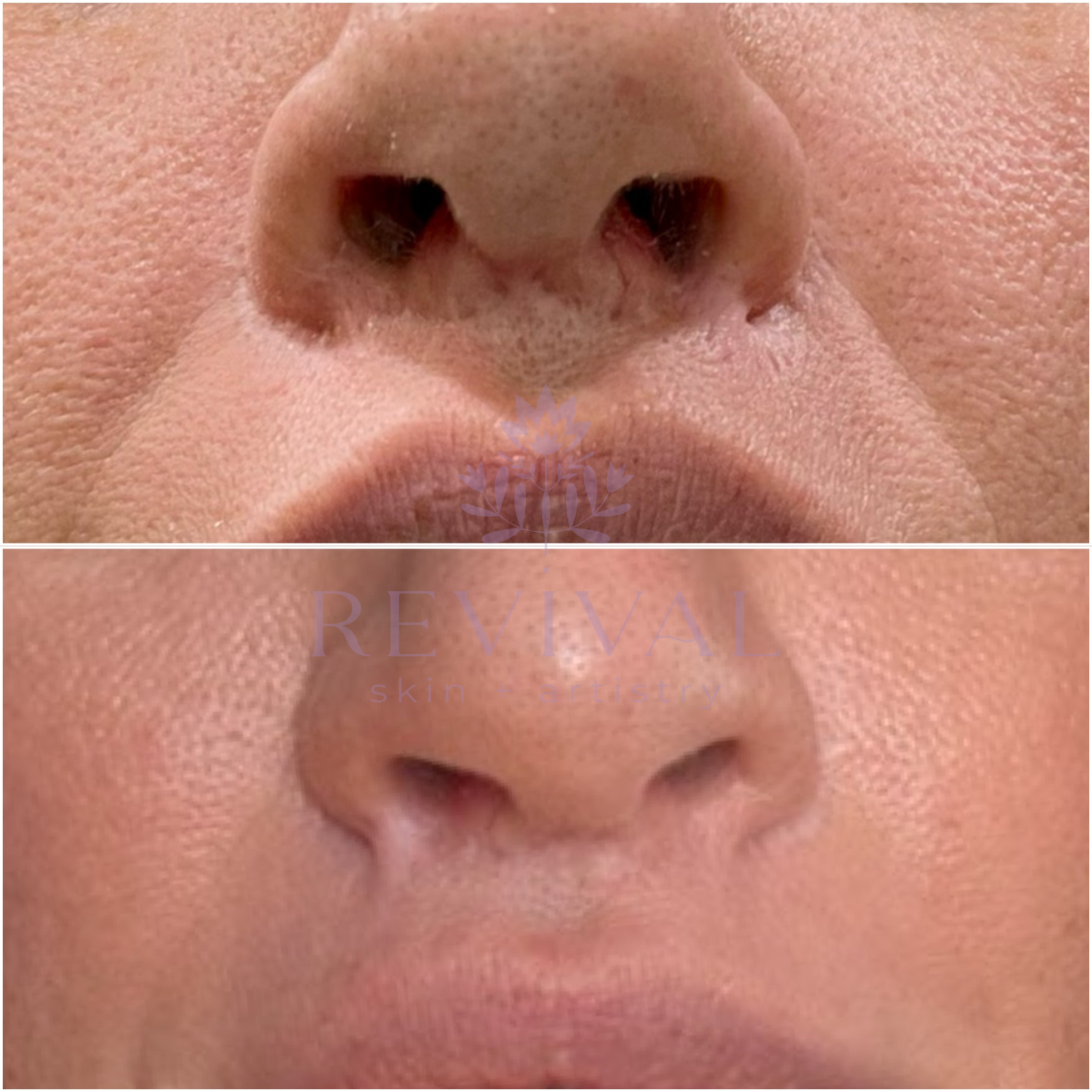 Scar Reduction Post-Lip Lift