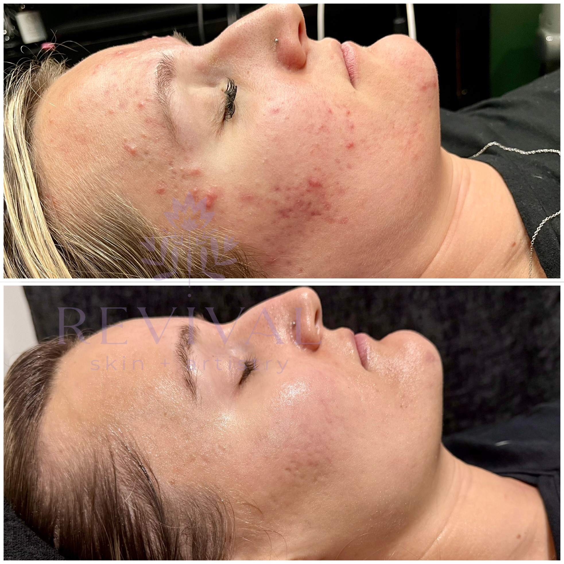 corrective peel before and after