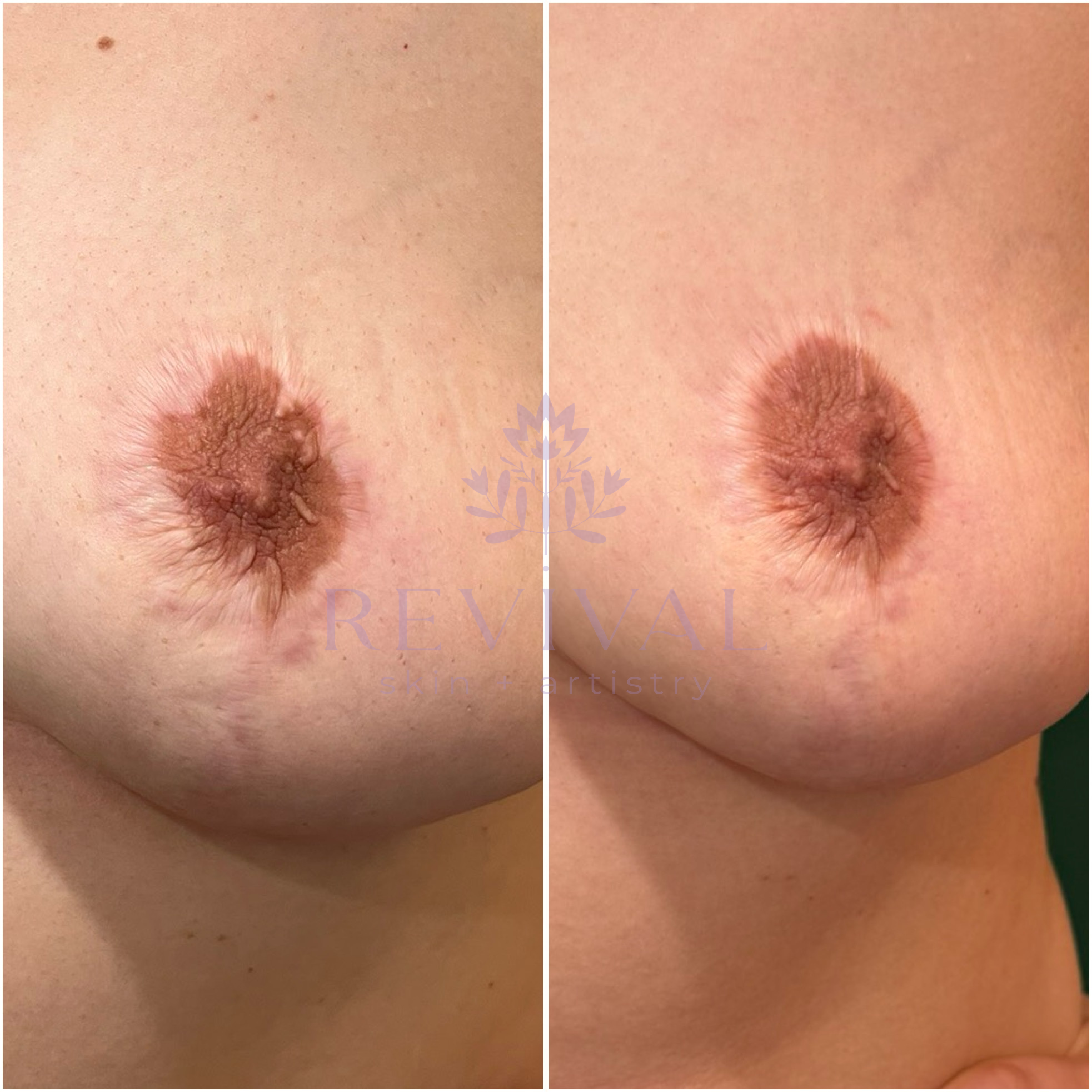 Areola Correction Tattoo
