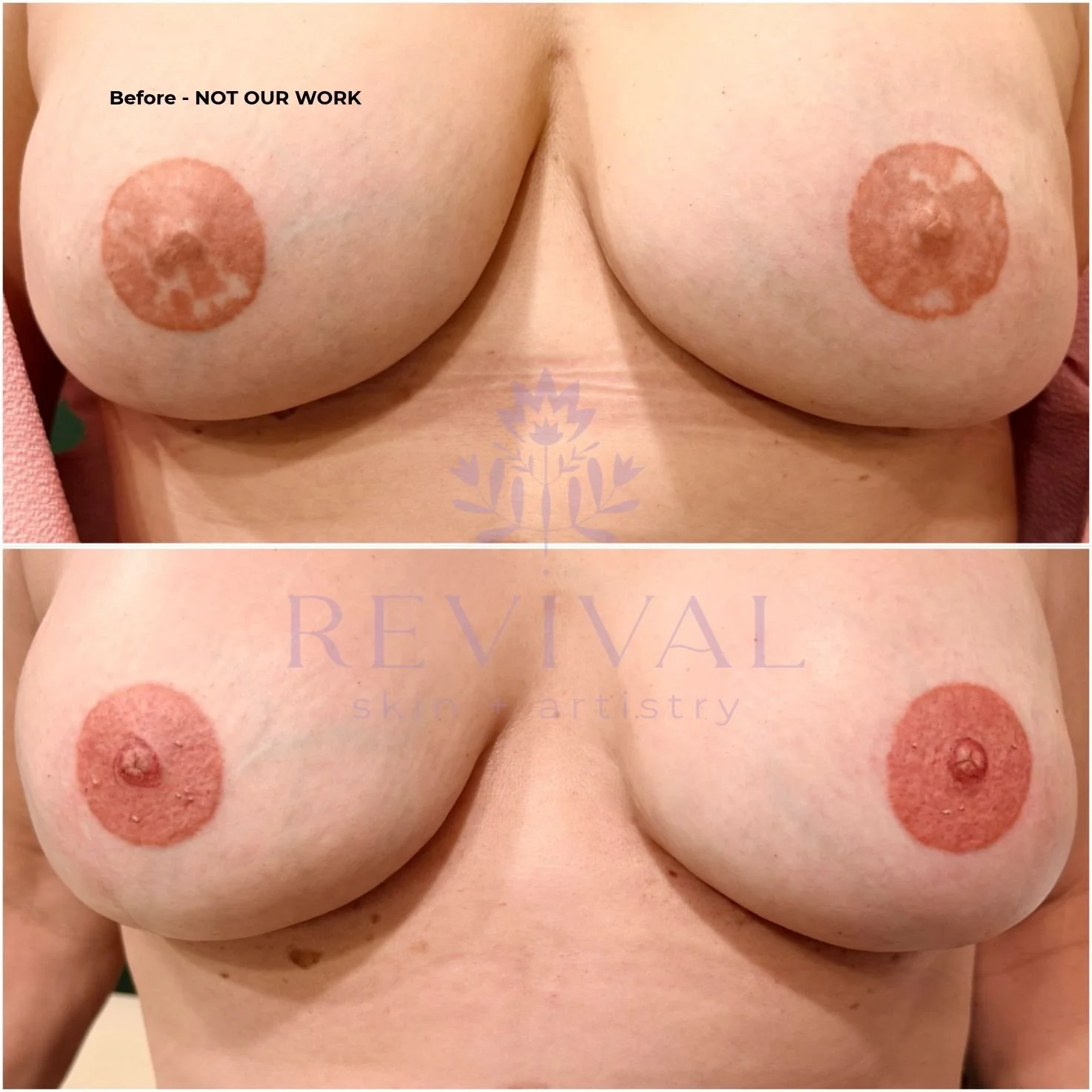 Areola Restoration Areola Correction