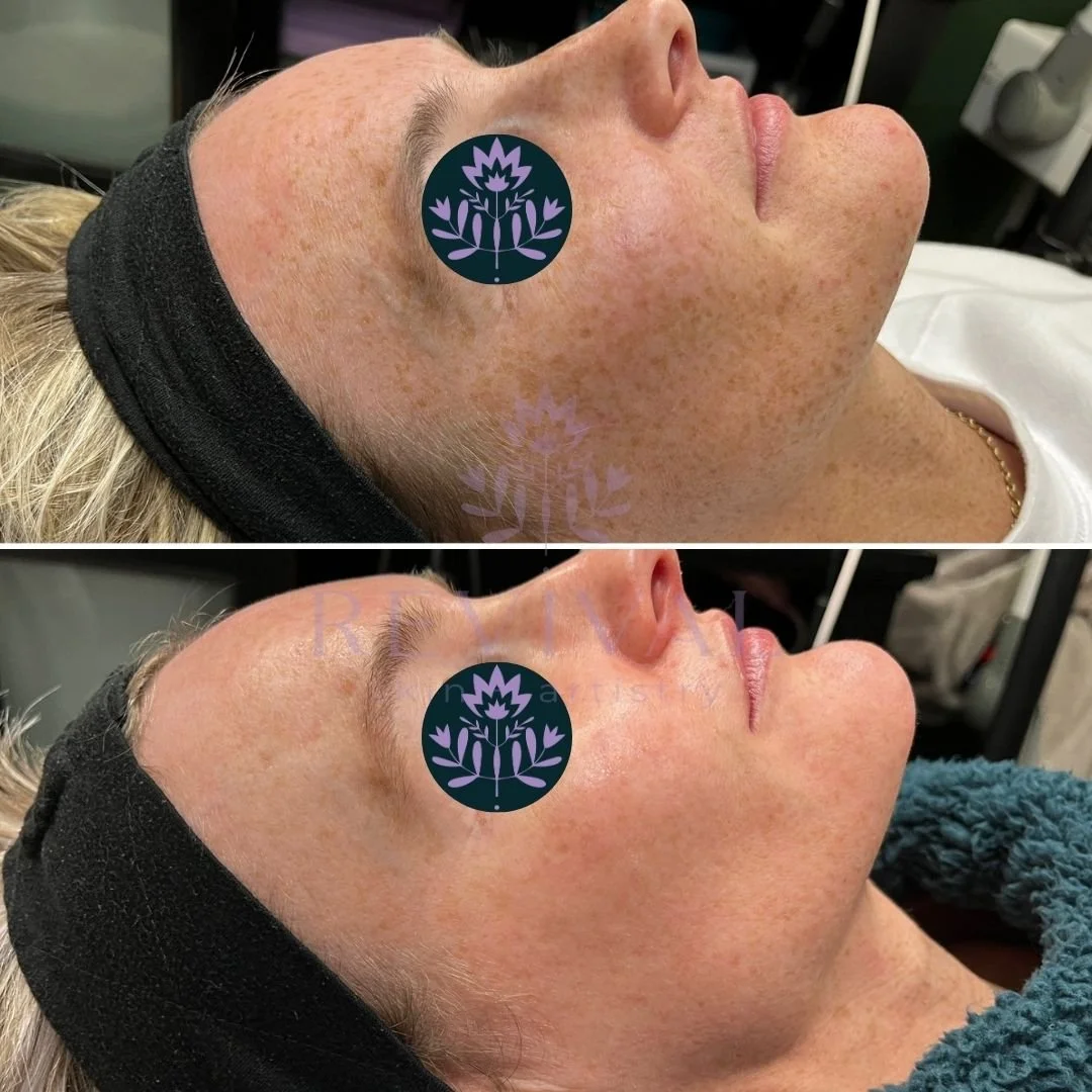 microneedling hyperpigmentation