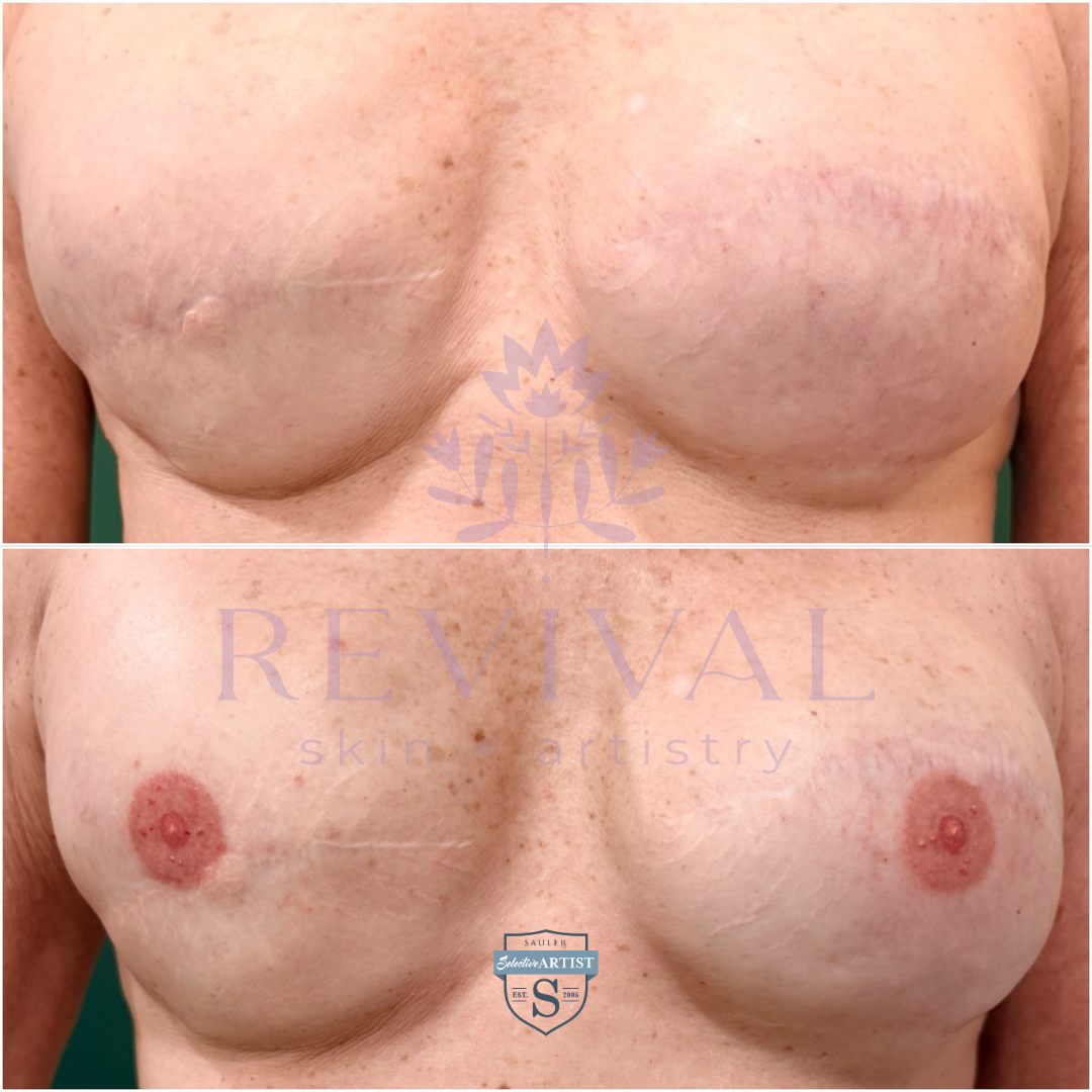 areola restoration 3d nipple tattoo