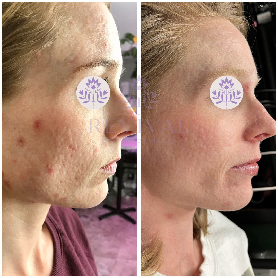 microneedling for acne scars