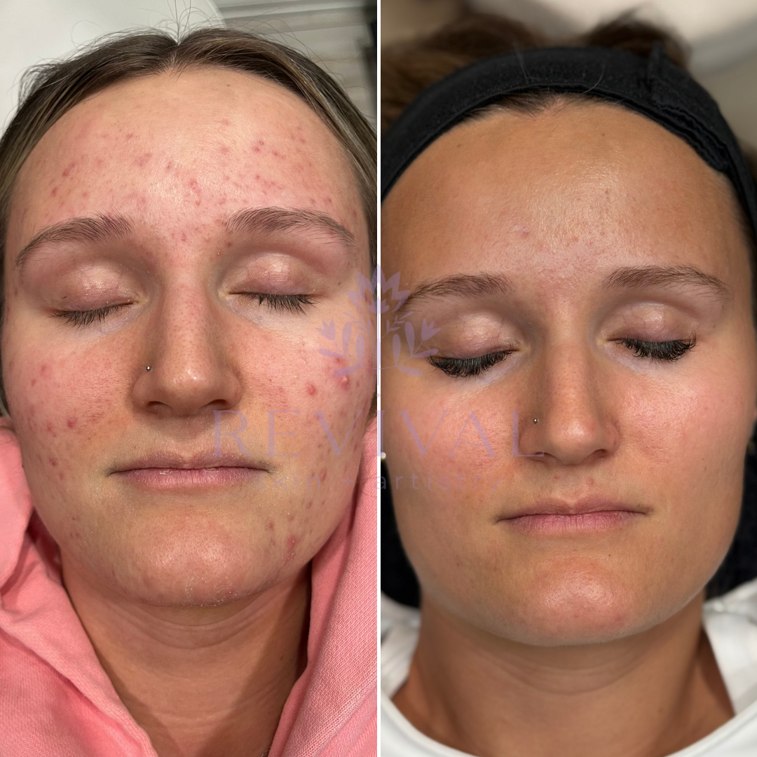 peel + microneedling acne