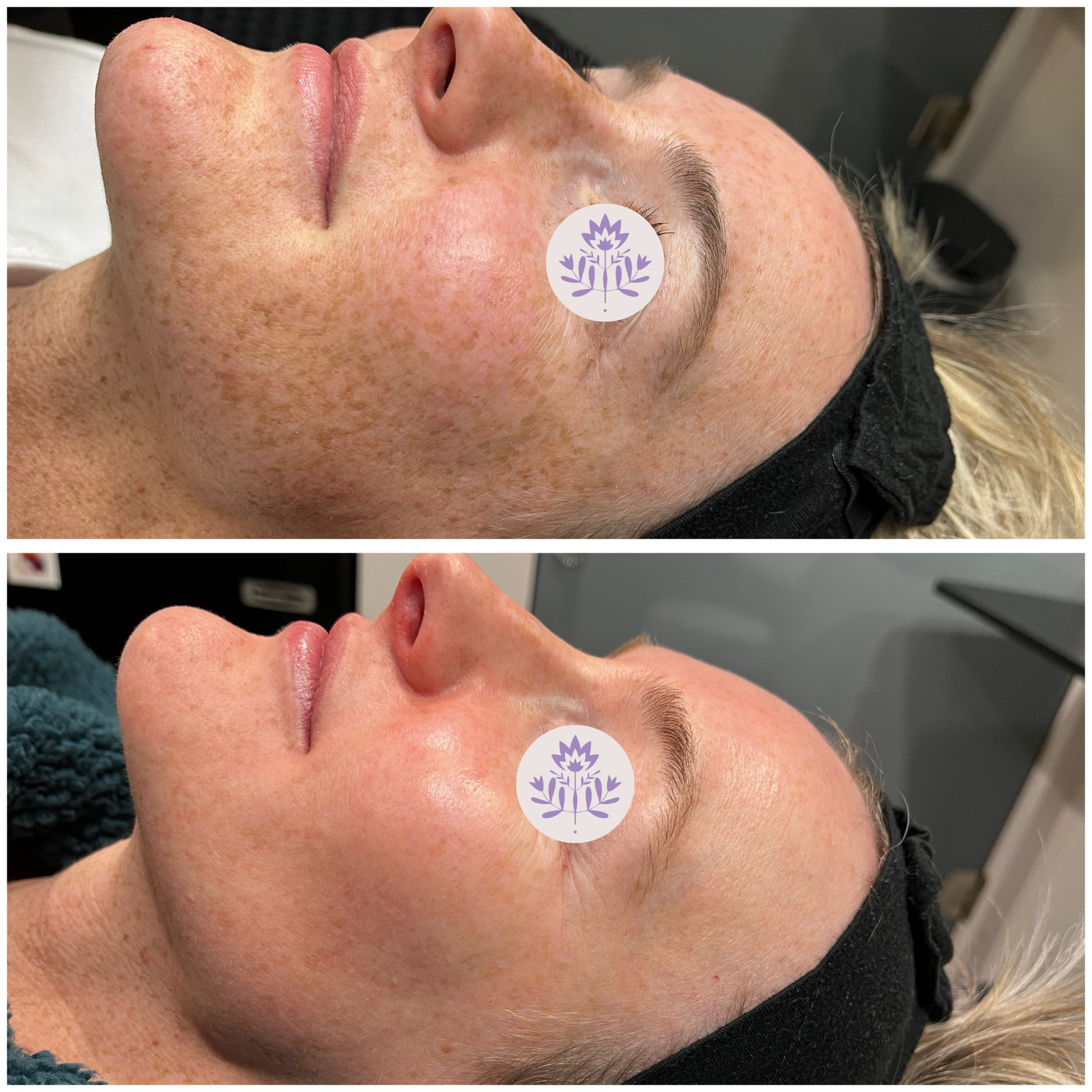 Microneedling before and after