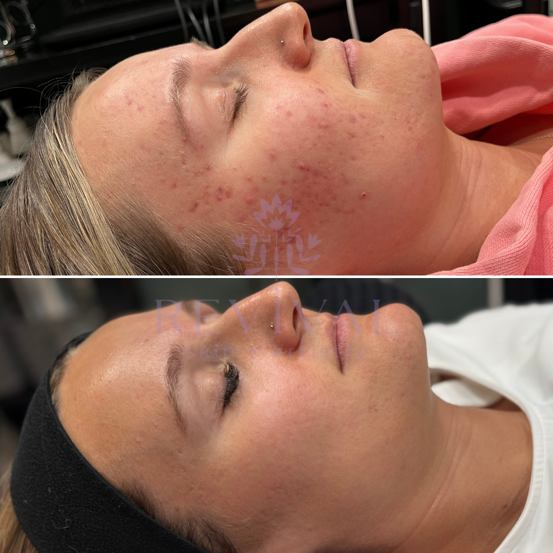 before and after microneedling denver