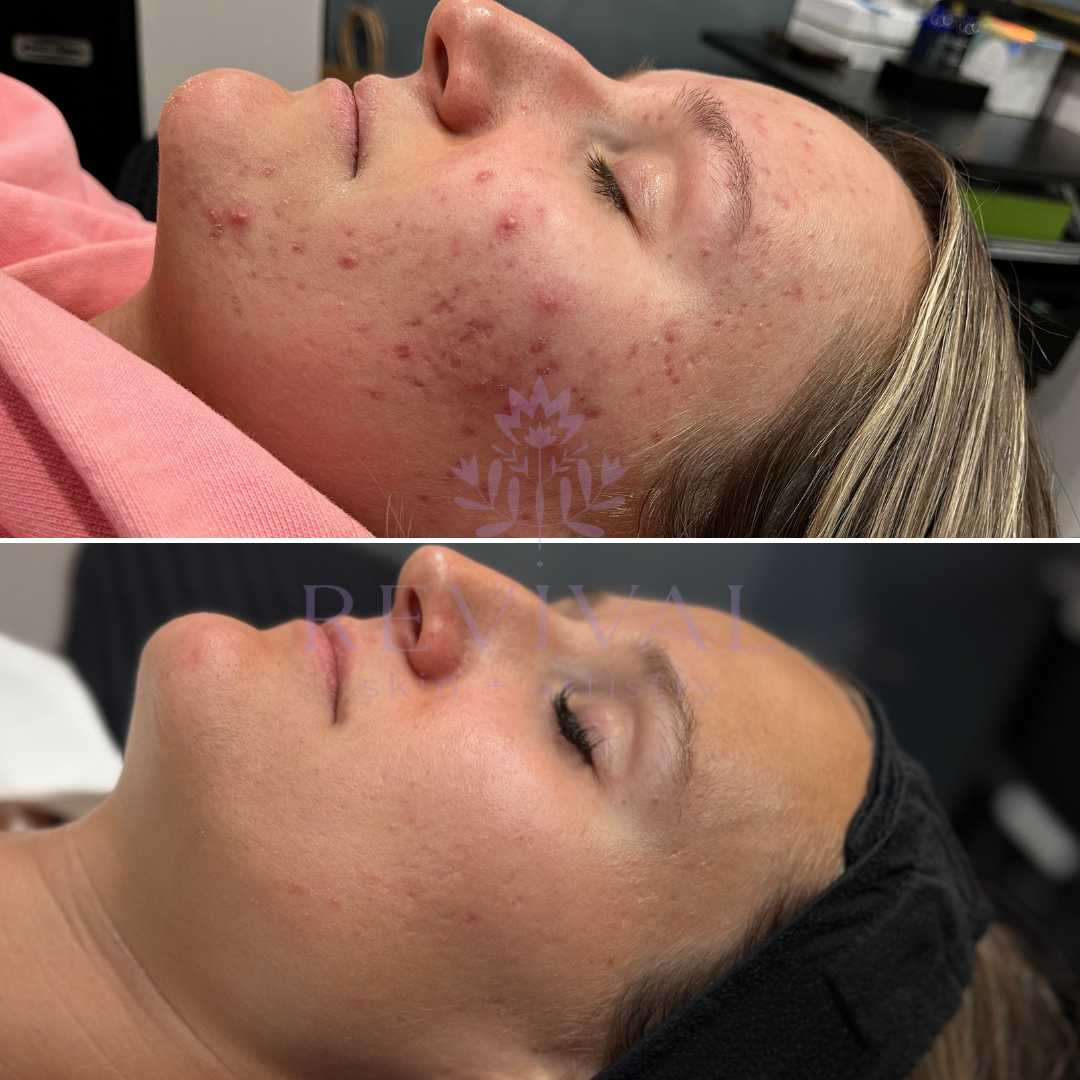 microneedling before and after