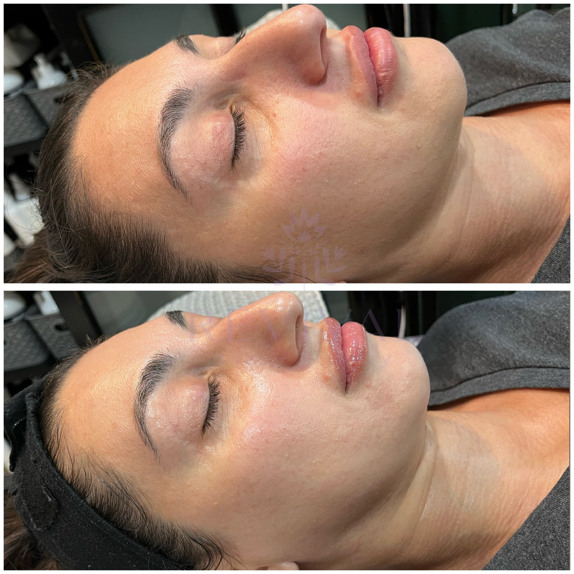 glo2facial treatment