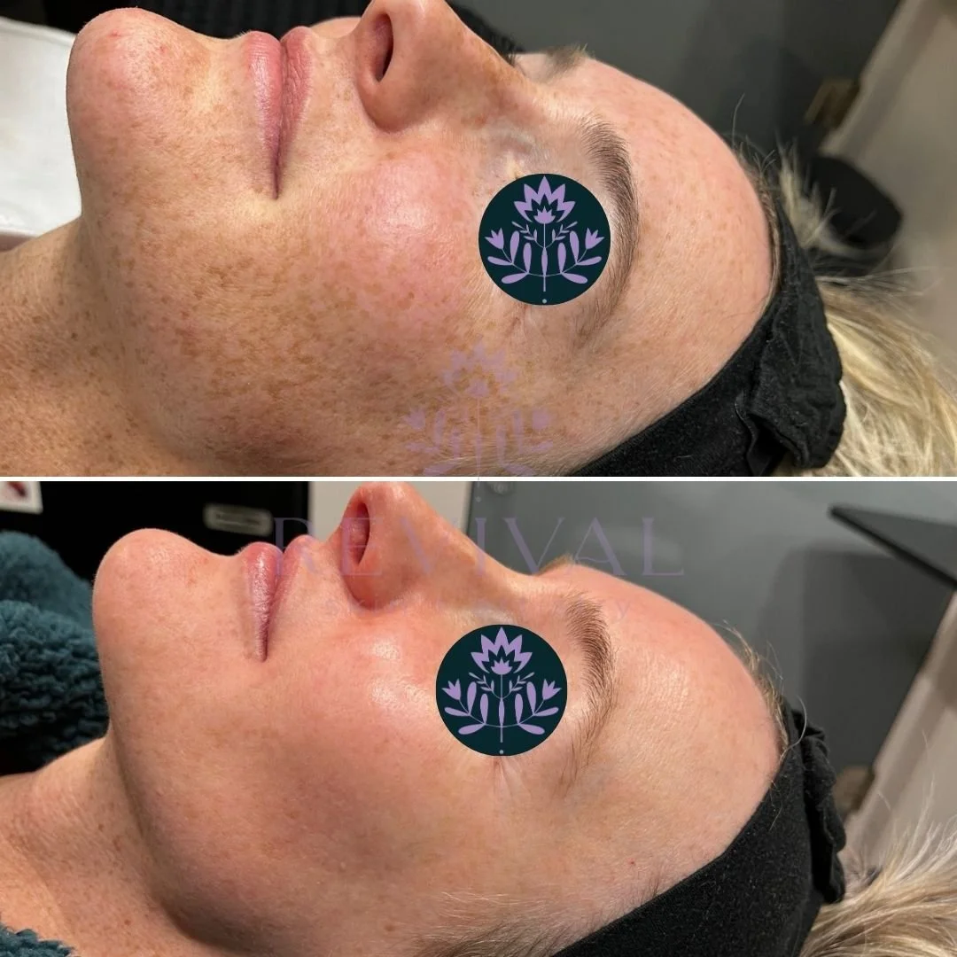 Microneedling Hyperpigmentation Denver