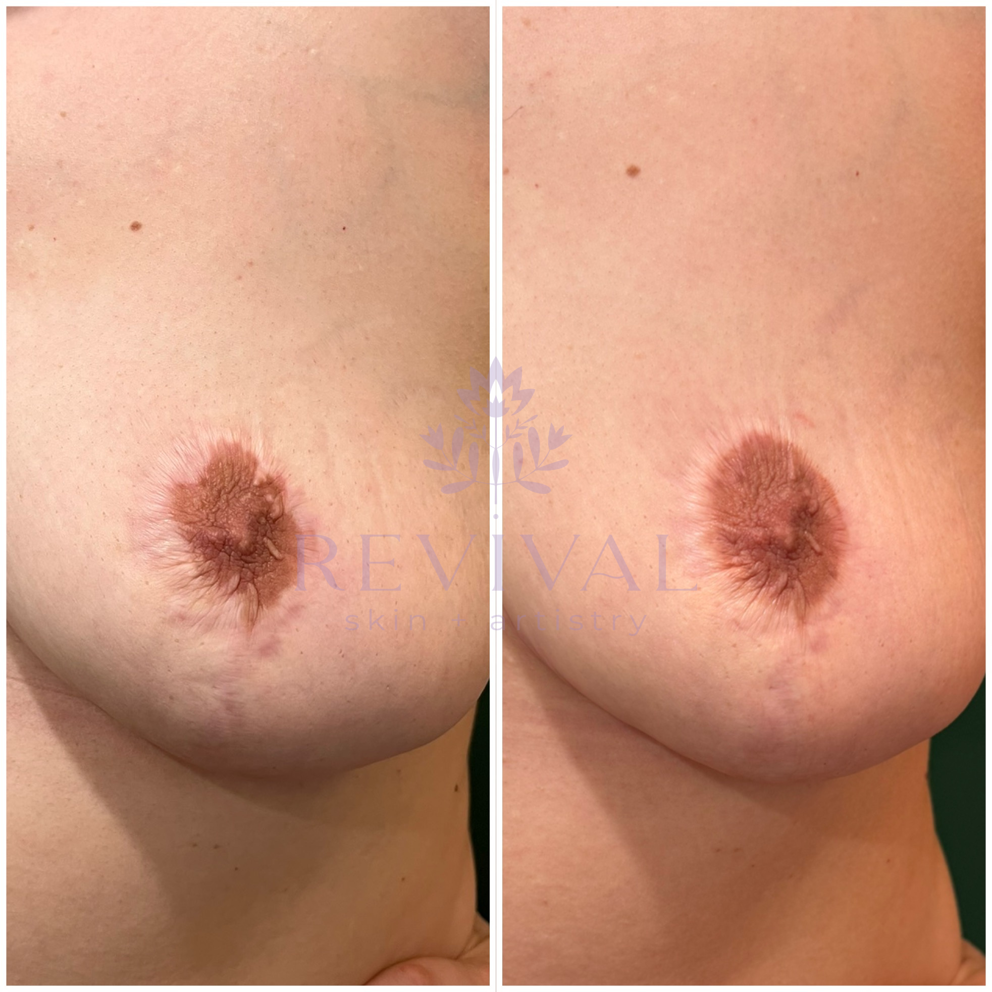 Areola Correction Tattoo