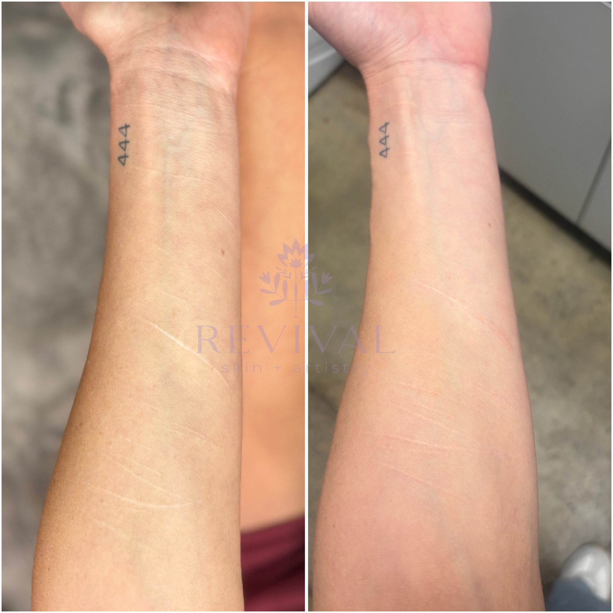 Self-harm scar camouflage
