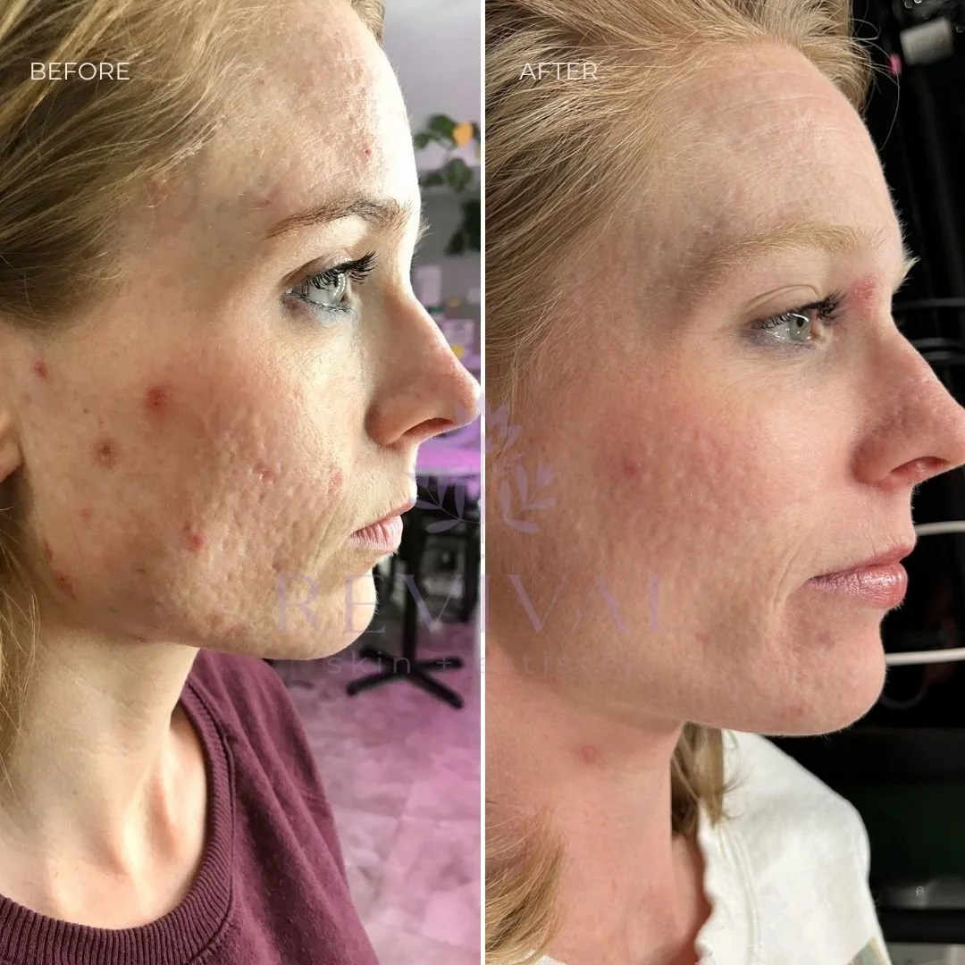 Microneedling Lakewood