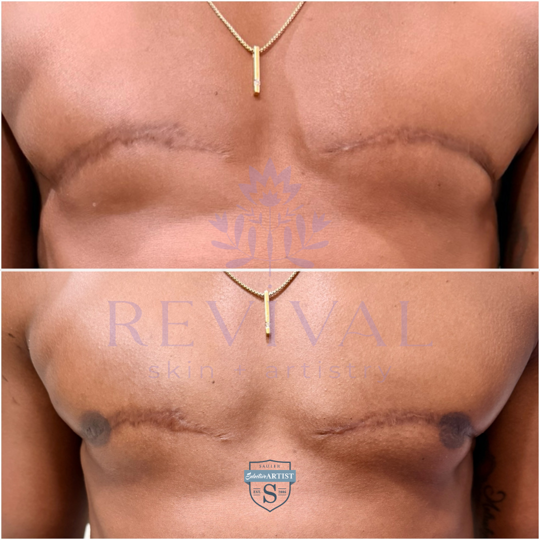 Bilateral Areola Restoration