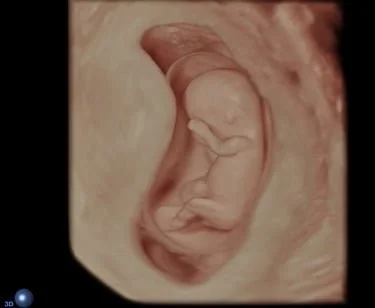  Erstes Drittel, 3D-Ultraschall eines Feten in der Gebärmutterhöhle 