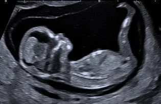  Fet im ersten Trimenon 2D 