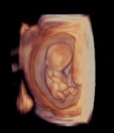  Fet im 1. Schwangerschaftsdrittel 3D 