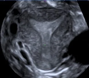  Gebärmutter im 3D Ultraschall 