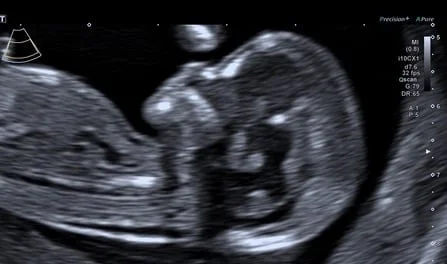  Gesichtsprofil mit Nackenfalte im Ersttrimesterscreening 