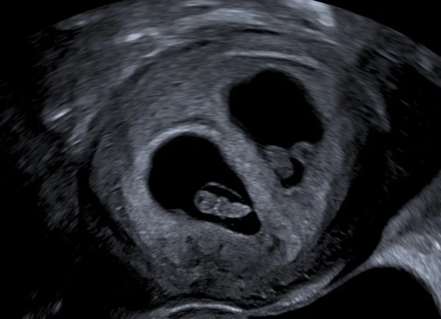  Zwillinge Frühschwangerschaft 2D 