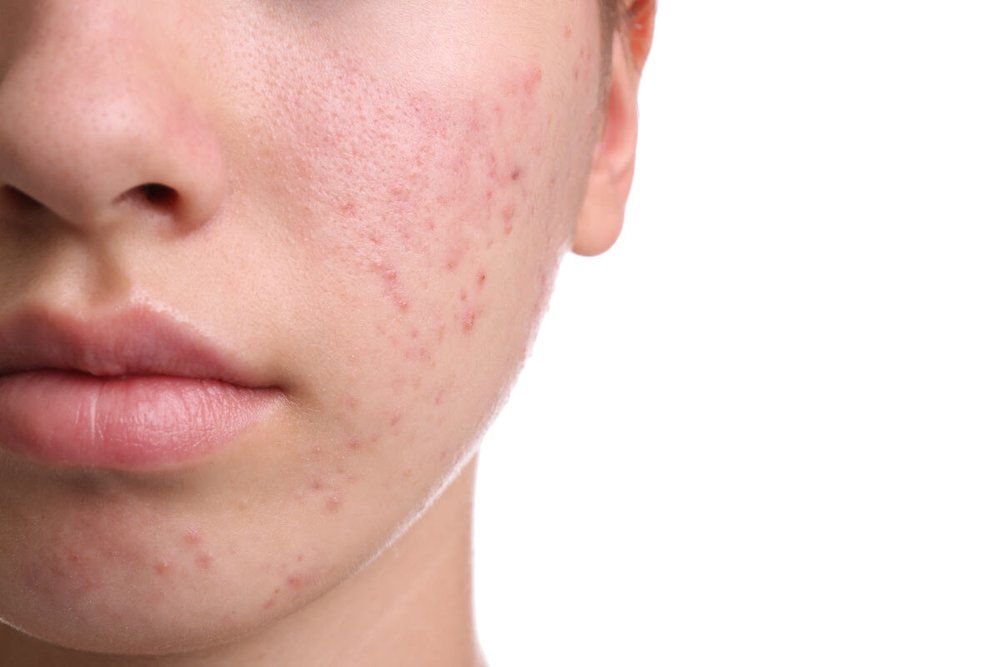 Acne — North Point Dermatology & Mohs Surgery
