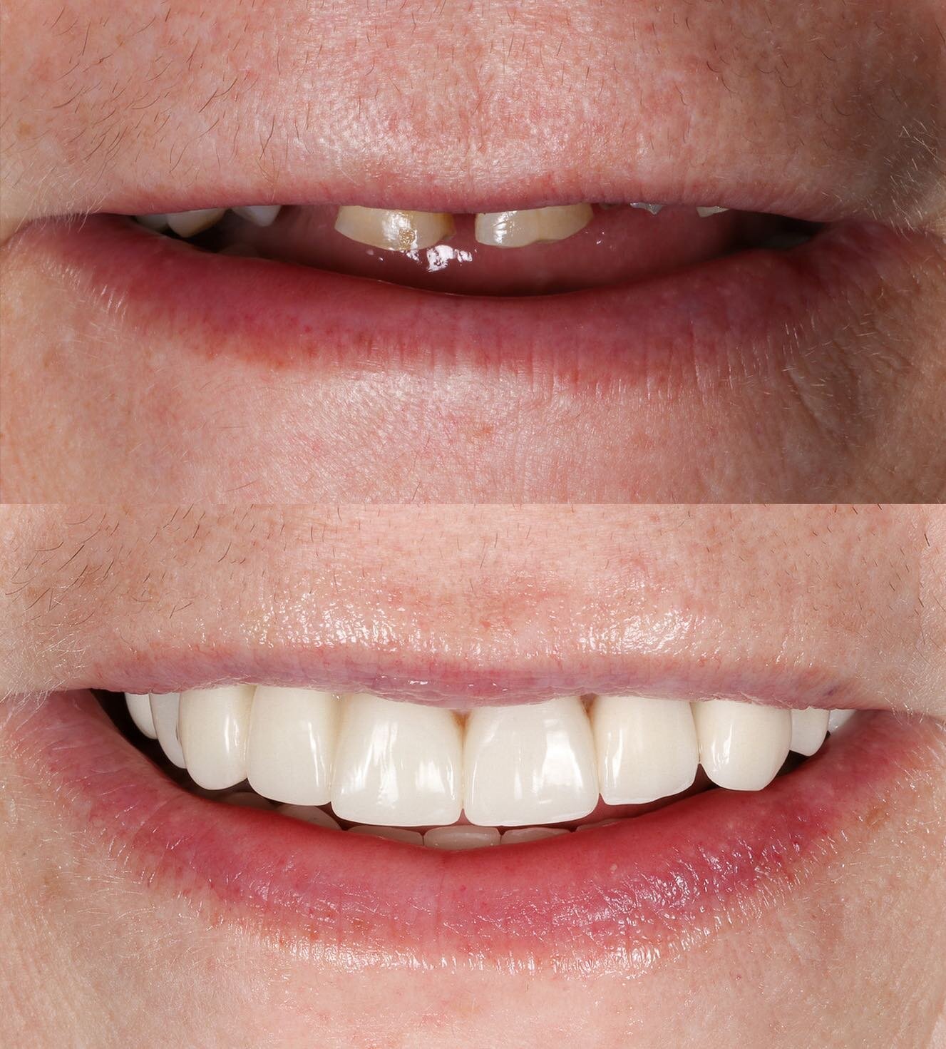 Full mouth rehab to restore this patients smile and confidence. 

Crown lengthening performed in the anterior, VDO was increased, edentelous posterior areas were restored with RPDs. Anterior missing teeth made it harder to get ideal contours / length