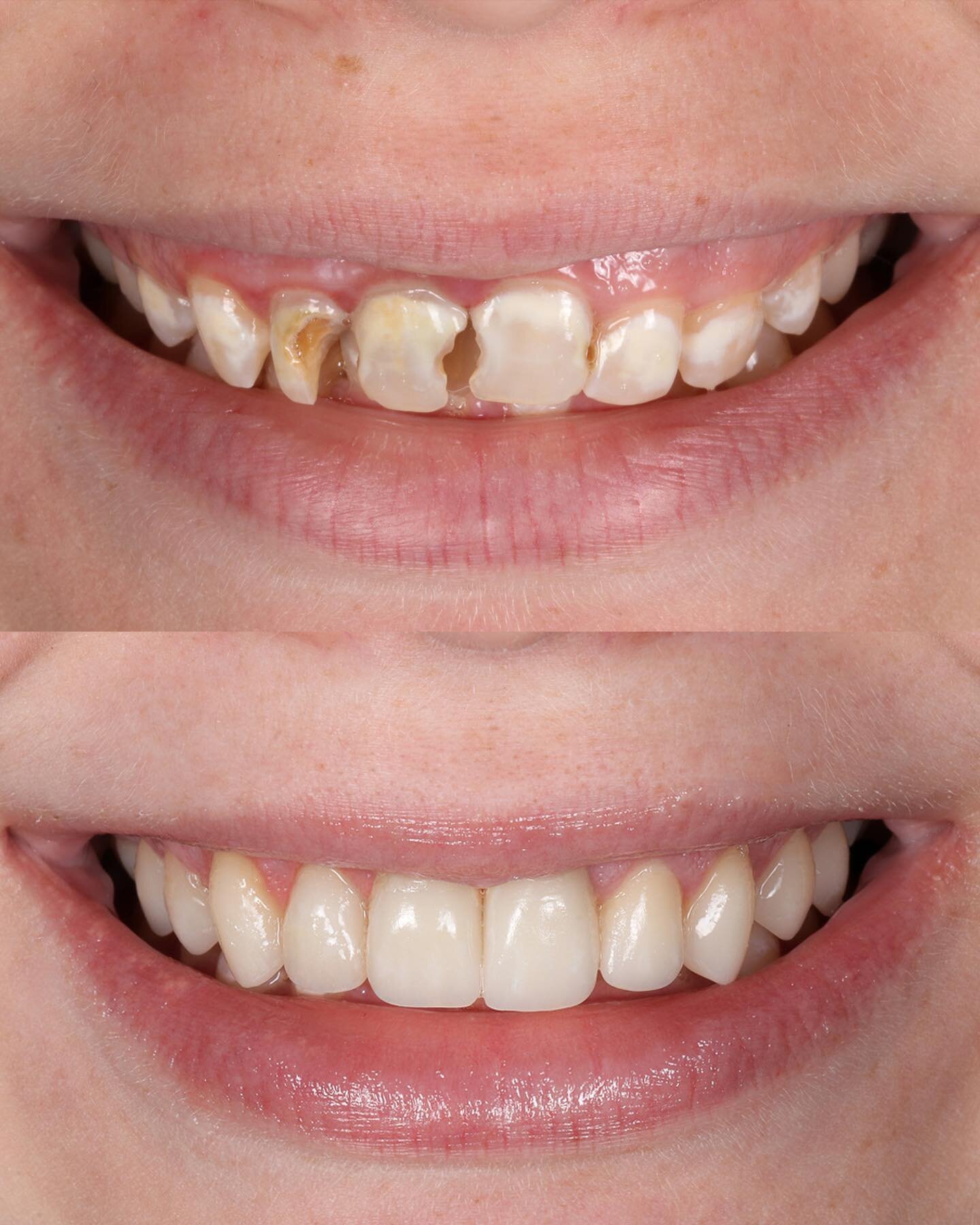 Mix of crowns, veneers, and crown lengthening to give this patient a beautiful smile that she loved 

RCTs were completed on the teeth that were non-vital. Crown lengthening from 4-13 to remove excess gingiva, and lengthen her teeth. Finally, self mi