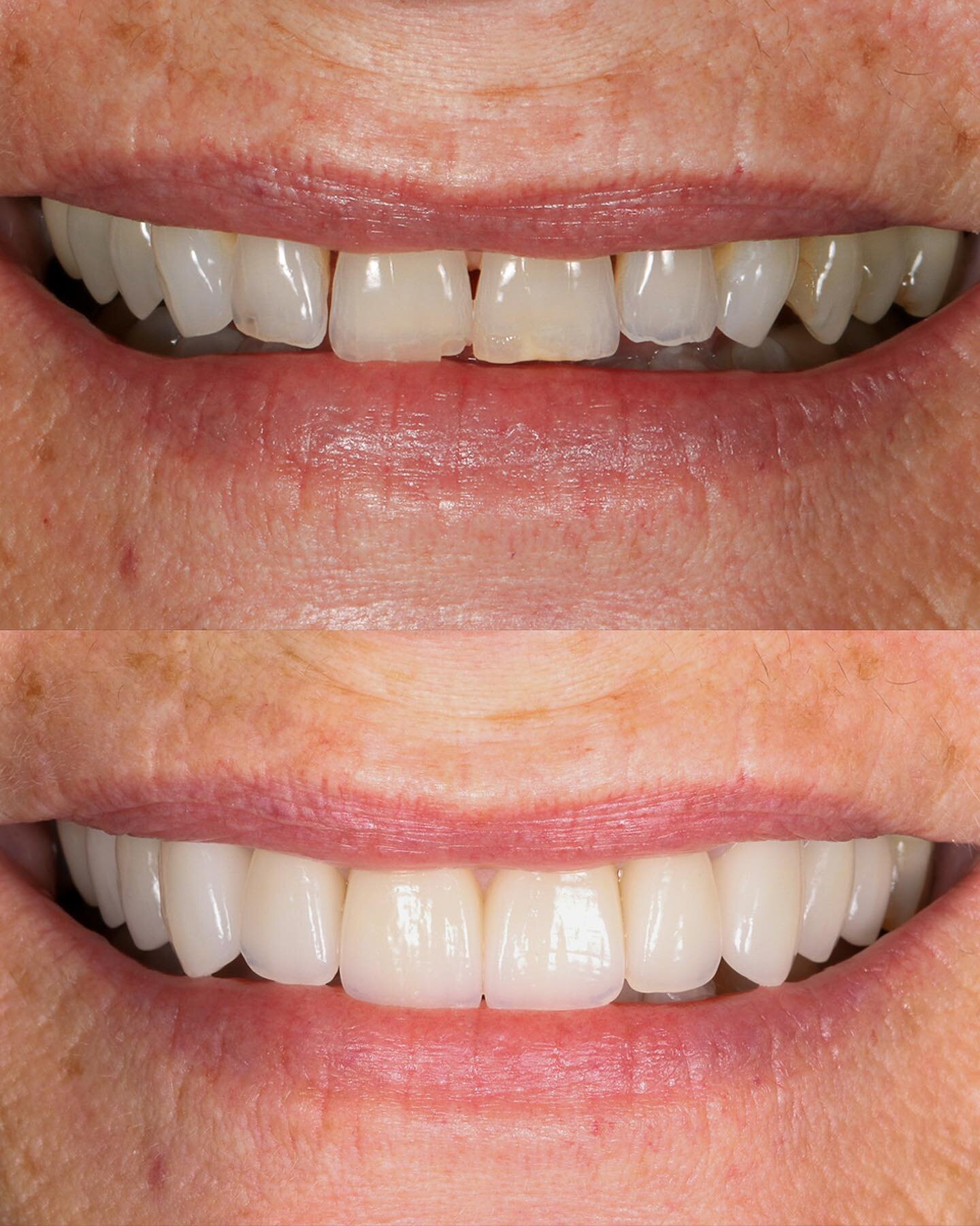 Mix of crowns and veneers to improve an aged smile to a more youthful but still natural smile. Black triangles were fixed, worn incisal edges, and abfractions. While maintaining the same overall shapes, texture and translucency. 

Great work by @gil_