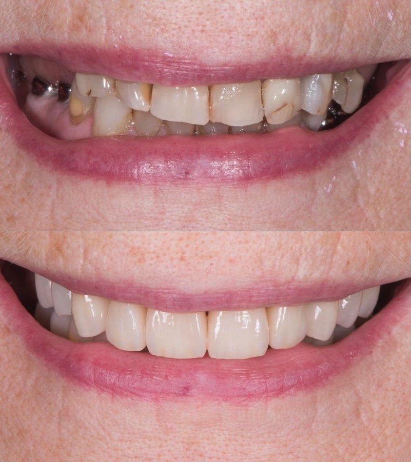 Kuluneet ja lohkeilevat hampaat Helsinki