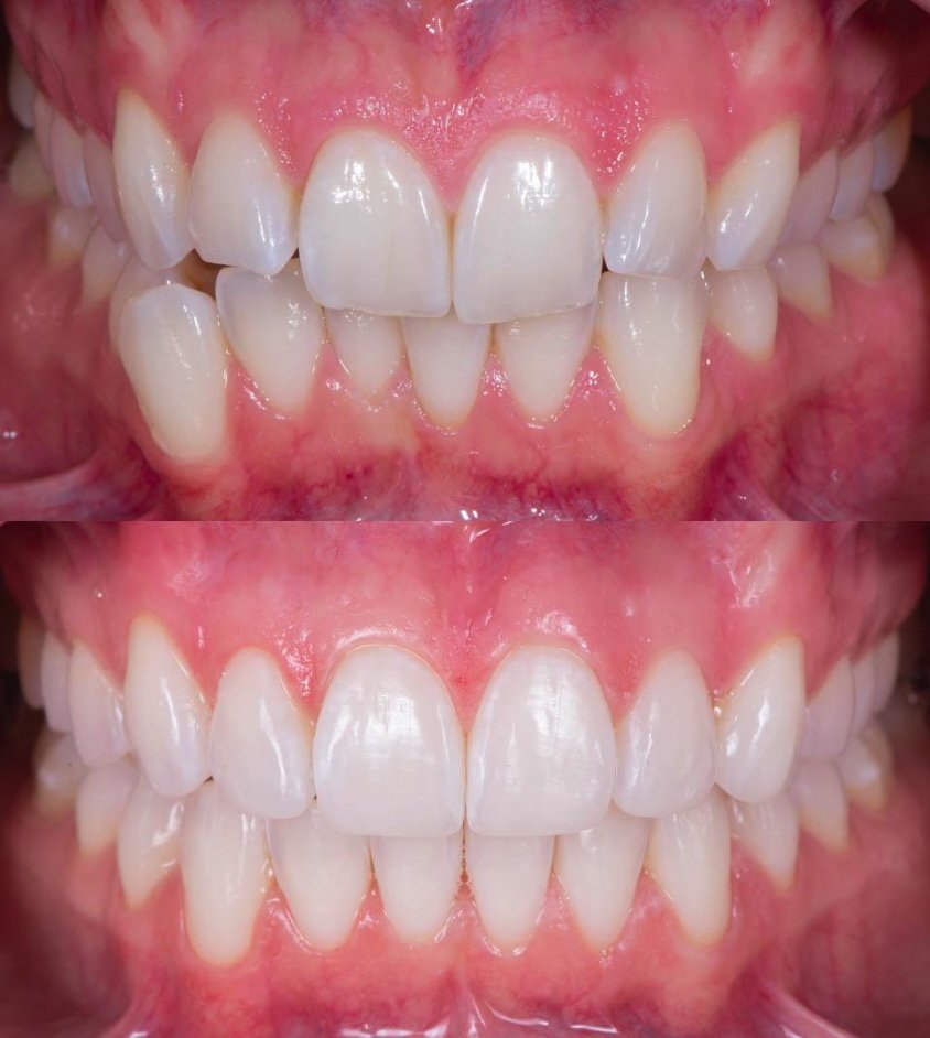 Hampaiden ahtaus hammashoito Helsinki