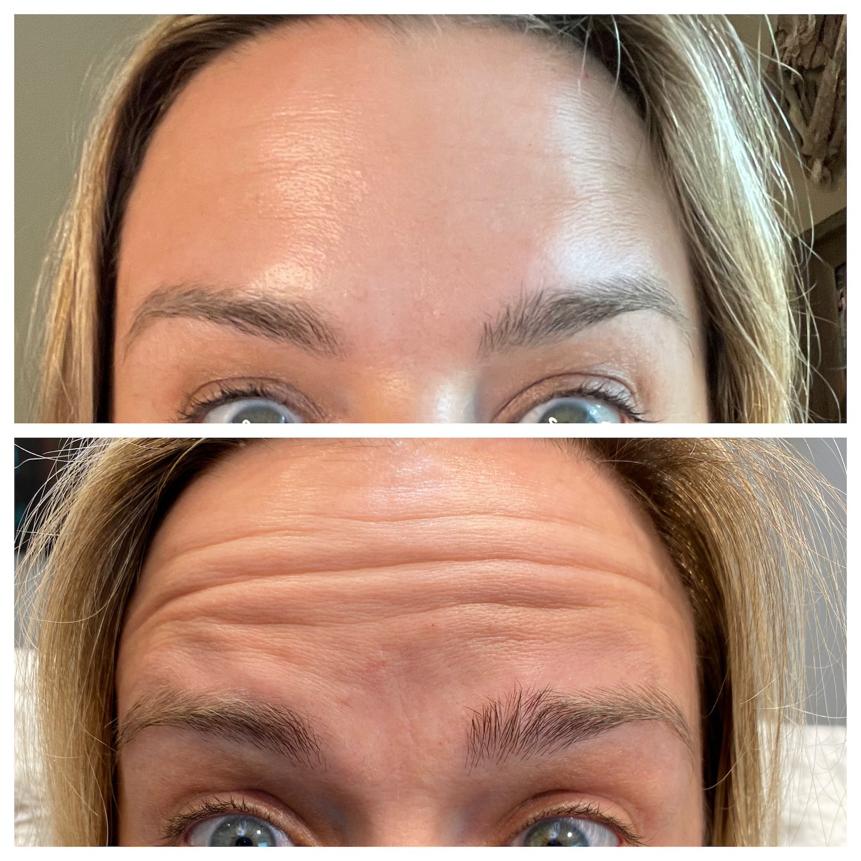 Caravela-forehead-injectables-3.jpeg