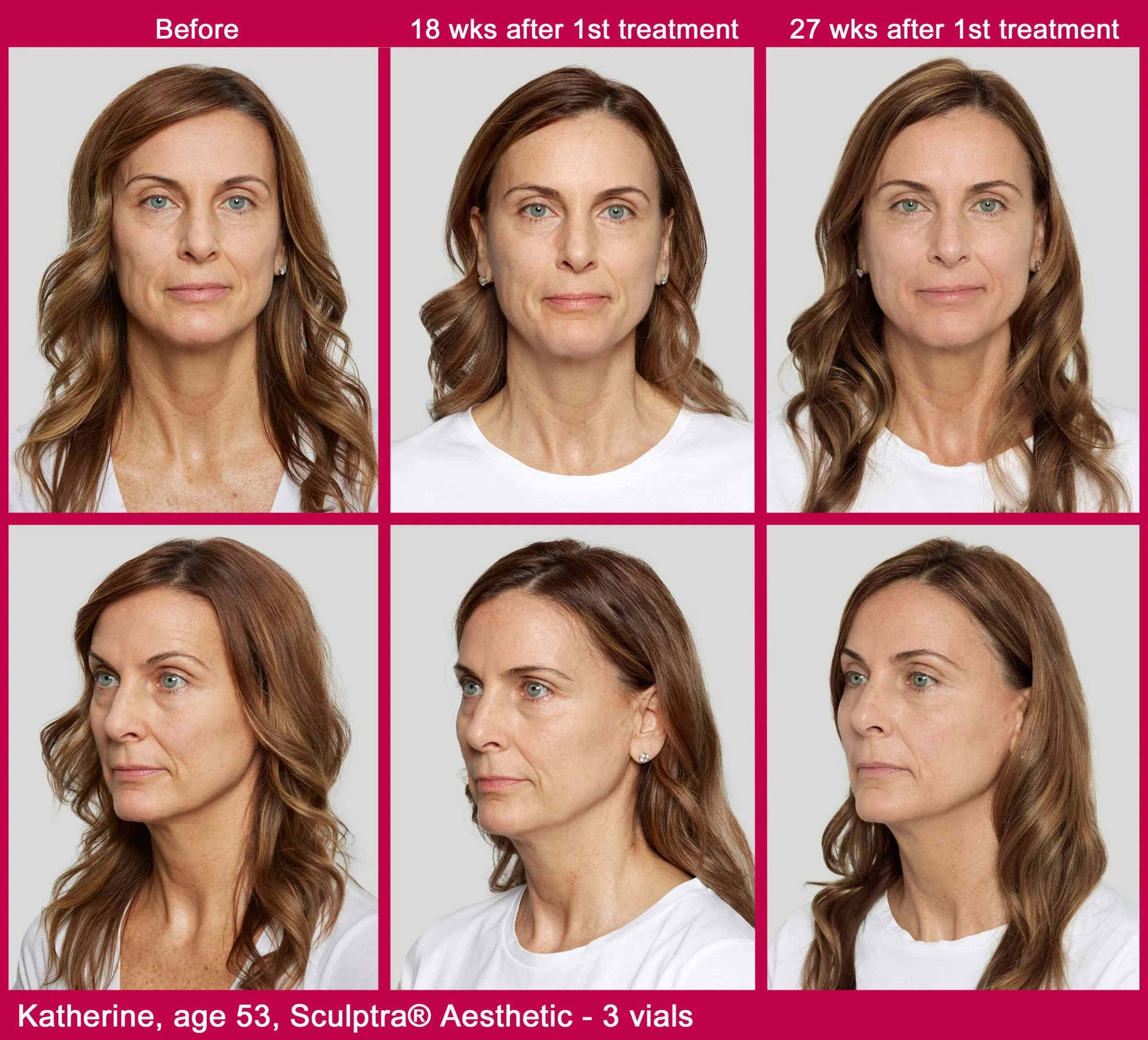 Sculptra vs. Facelift: Which Option Is Right for Facial Rejuvenation?