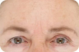 Deep-Brow-Lines-Before.jpeg