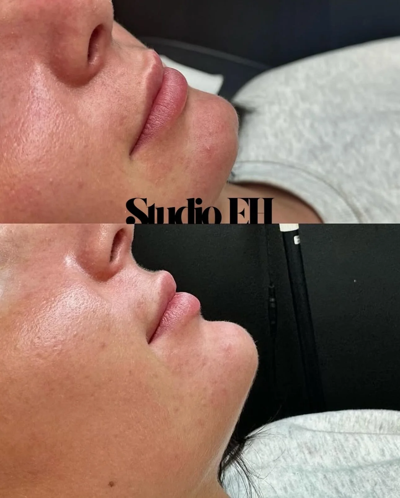 Side-by-side comparison of a woman's profile before and after a cosmetic procedure on her nose and lips, showing smoother skin and refined features.