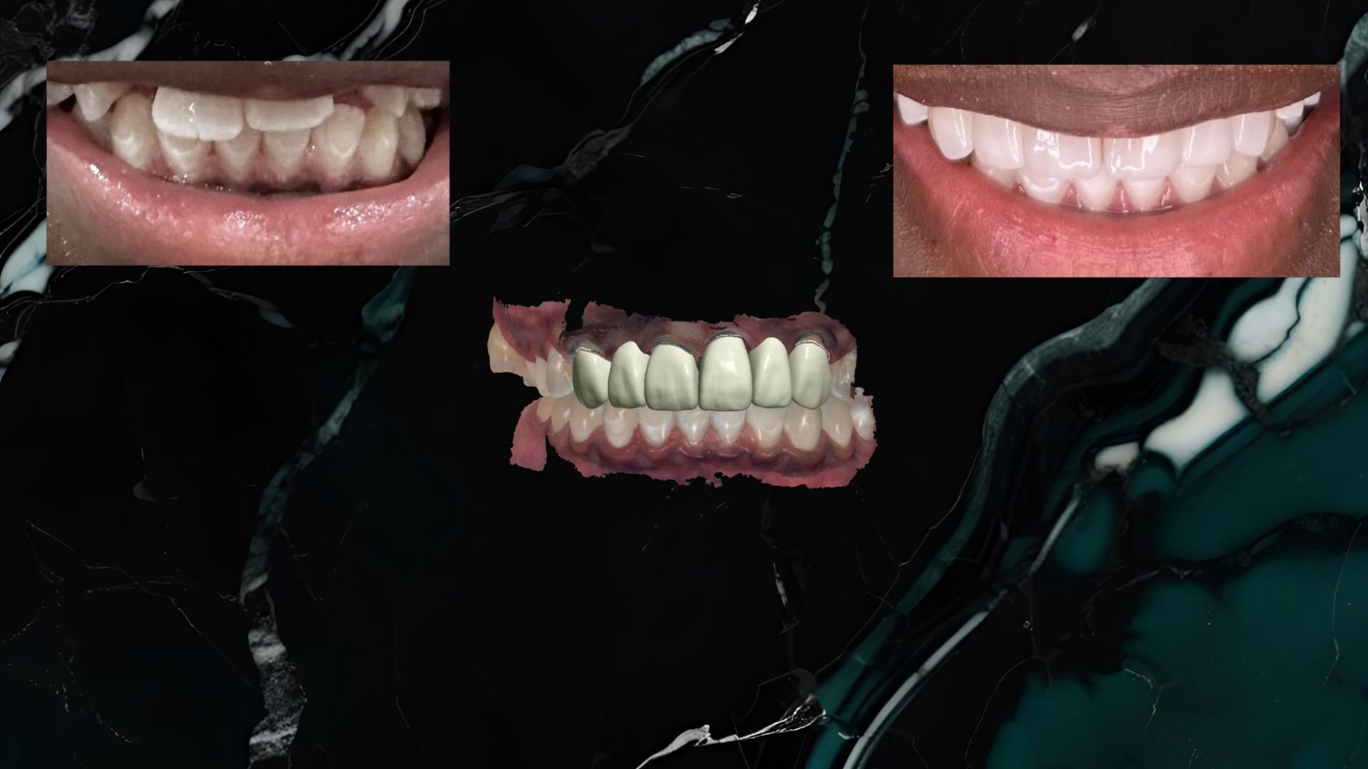 Comparison of teeth before and after dental treatment, showing two sets of teeth with the middle set representing the treatment result, with close-up images of the upper and lower teeth.