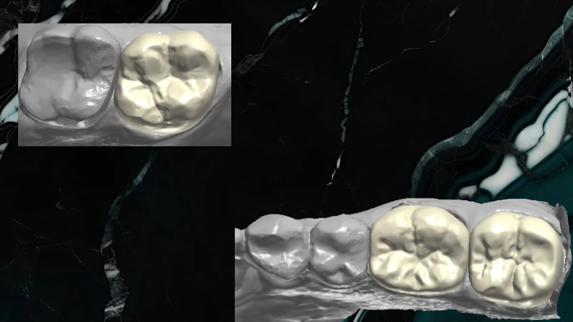 Digital illustration of three molar teeth, with two appearing in white and the third in a cream color, set against a dark background with abstract patterns.