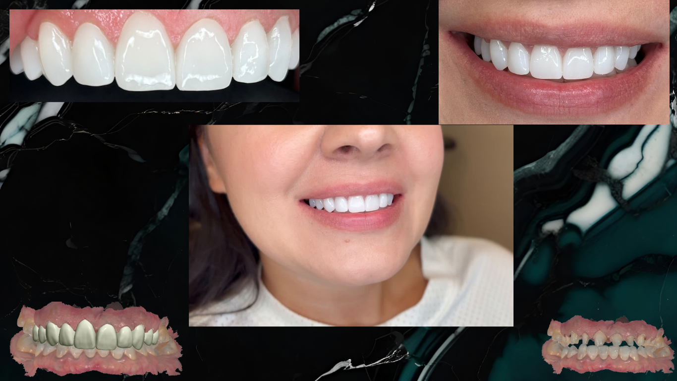 Collage of images showing close-ups of teeth, a person's smile, and dental veneers.